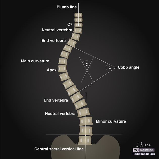 1597996660761026.jpeg definitions-scoliosis.jpeg